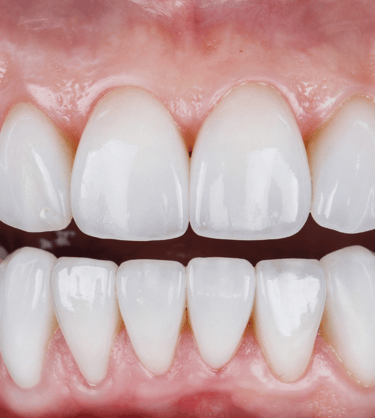 Facetas dentárias para um sorriso perfeito na clínica médica e dentária em Setúbal.