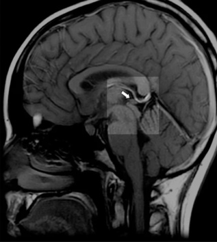 MRI scan of healthy normal pineal gland for meditation practice and spiritual wellness comparison"