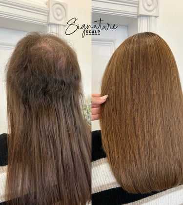 Signature Scalp Hair loss at HairLabUK 