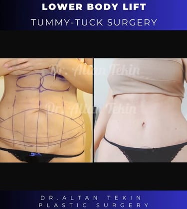 extended tummy tuck before after photos