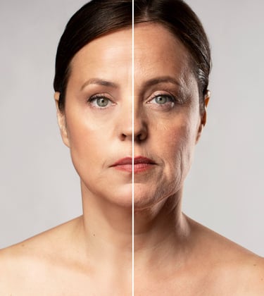 RF Microneedling comparison showing anti-aging treatment results on wrinkles and fine lines.