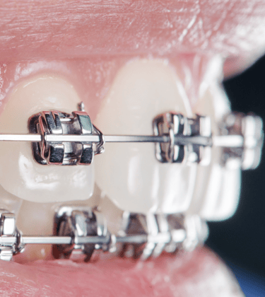Ortodontia em Setúbal, aparelhos fixos e alinhadores invisíveis para um sorriso perfeito