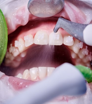 Higiene e saúde oral em Setúbal, prevenção de cáries e doenças gengivais com limpeza profissional
