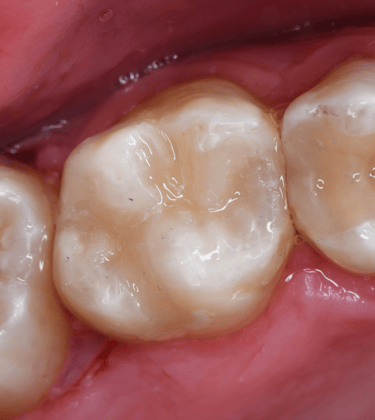 Dentisteria em Setúbal, restaurações dentárias estéticas para reparar dentes danificados.