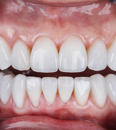 Facetas dentárias em Setúbal para transformar o sorriso com um aspeto natural e estético