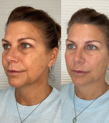 dermal filler and sculptra 