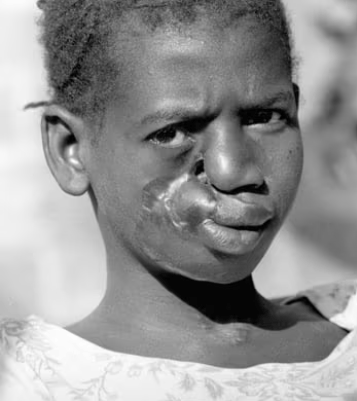 ნომა (განგრენოზული სტომატიტი) - samedicino-targmani.ge