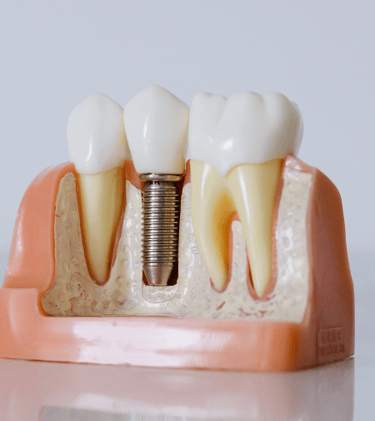 Tratamento de implantes dentários na Clínica do Convento, Setúbal – Recupera o teu sorriso.