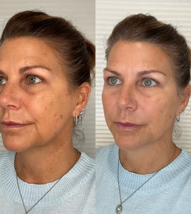 dermal filler and sculptra 