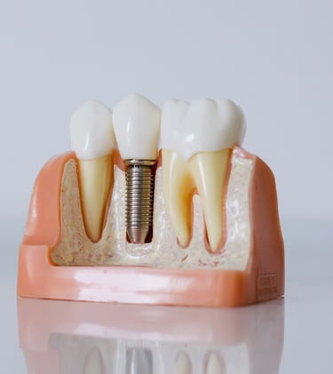 Tratamento de implantes dentários na Clínica do Convento, Setúbal – Recupera o teu sorriso.