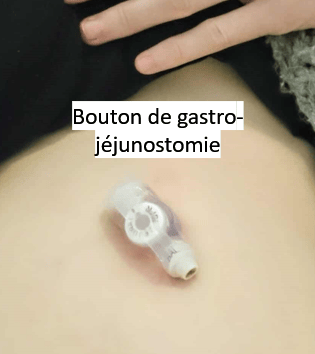 bouton de gastro-jéjunostomie