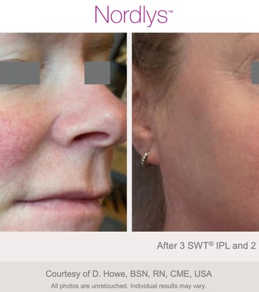 calmed and even skin tone after redness and vascular treatment in Hamilton Ontario