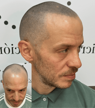 Micropigmentación Capilar en Madrid efecto rapado