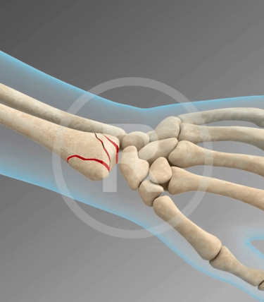 Wrist Fixation Medical Animation