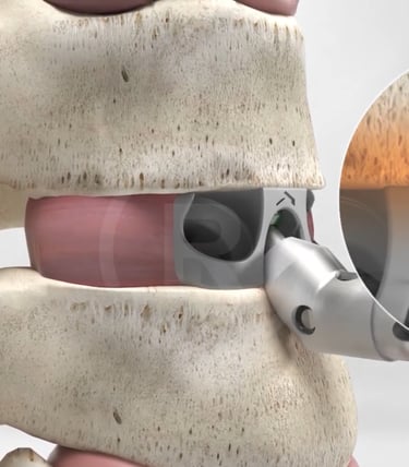 Screw Fixation On Spine Medical Animation