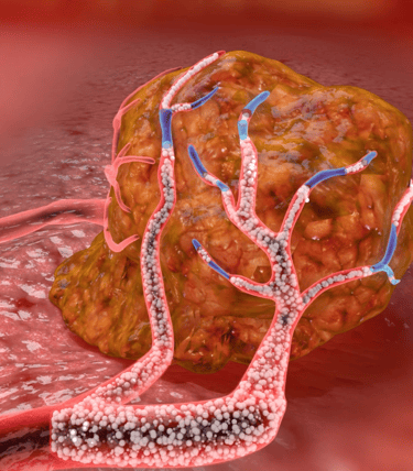 Tumor Medical Animation
