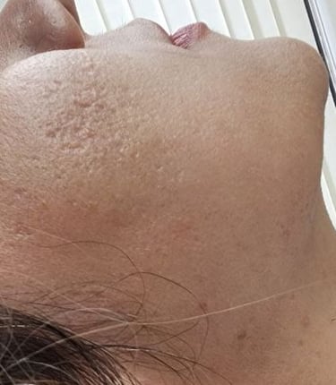 Acne scar treatment at Ariana Esthetic Edmonton.