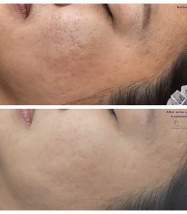 Acne scar treatment at Ariana Esthetic in Edmonton