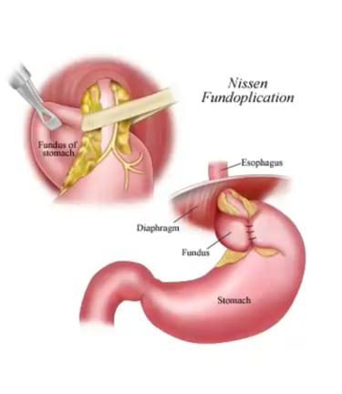 illustration of nissen fundoplication
