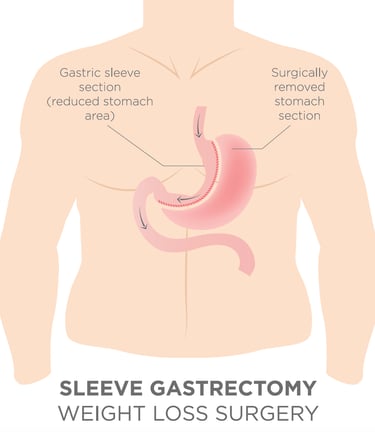 illustration of sleeve gastrectomy