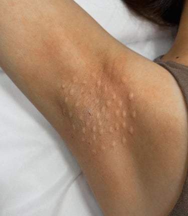 tratamento hiperidrose em bh