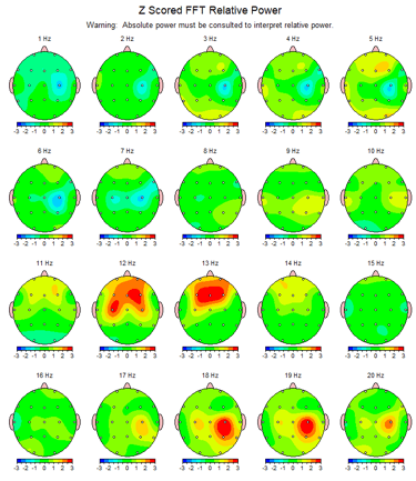 image d'un exemple de cartographie cerebrale 