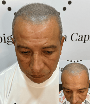 Simulación de folículos capilares post injerto