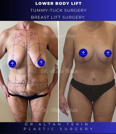 Body Contouring After Weight Loss