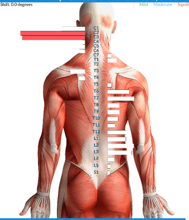 Vagus nerve stress from birth trauma causing tongue tie and latching issues
