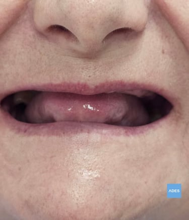 Paciente recibiendo implantes dentales en Badajoz