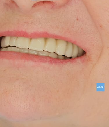 Sonrisa después de implantes en Badajoz