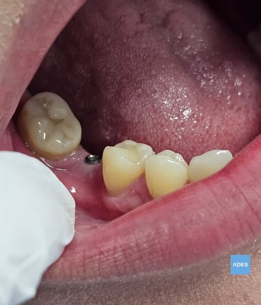 Servicio de implantes en Badajoz
