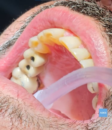 puente sobre implantes
