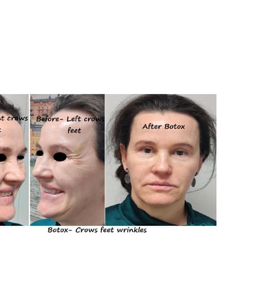 Före- och efterbilder av botox runt ögonen – slätare hud och yngre utseende.