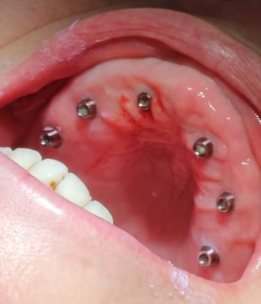 implantes colocados