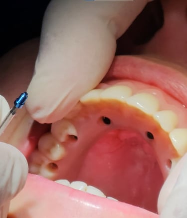 protesis sobre implantes