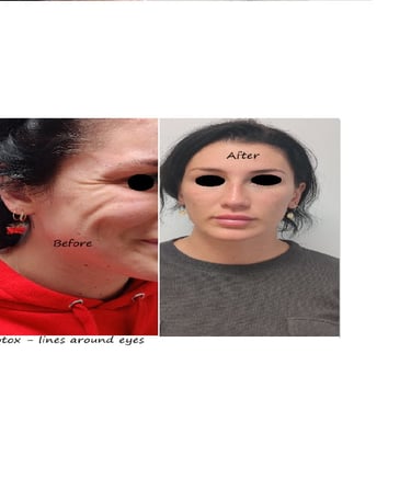 Före- och efterbilder av botox runt ögonen – slätare hud och yngre utseende.