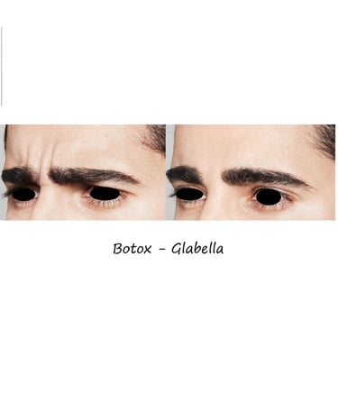 Före- & efterbild botox glabella – slätare bekymmersrynkor och avslappnat, harmoniskt utseende.