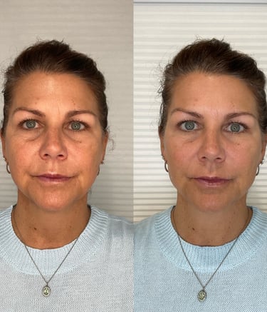 dermal filler and sculptra 