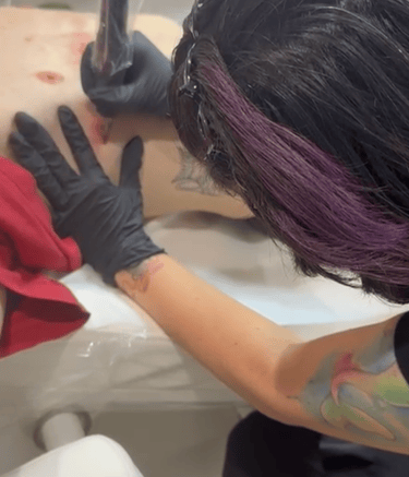 Scar camouflage tattoo procedure