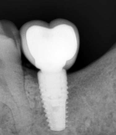 Best dental implants at Speciality Dental Clinic Malad Mumbai