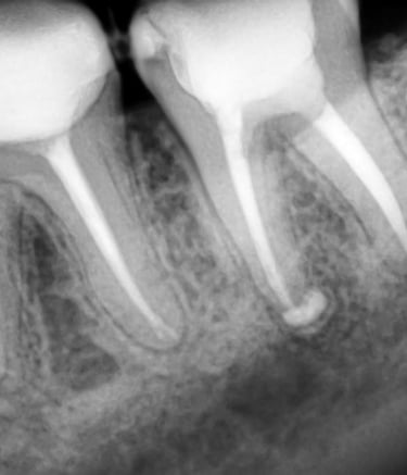Best root canal treatment done at top dental clinic near Chincholi Malad west in Mumbai