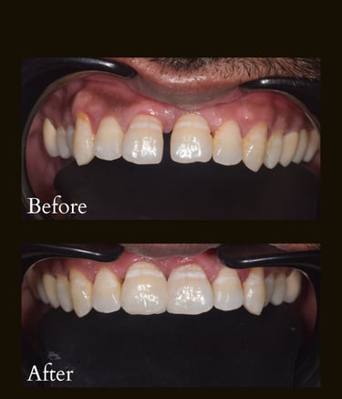 Teeth gap closure with Invisalign invisible braces and aligners done by best cosmetic dentist near Malad West in Mumbai