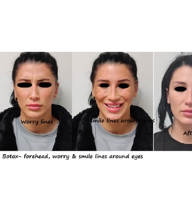 Before & after photos botox upper face – fresher, more appealing and more alert appearance.
