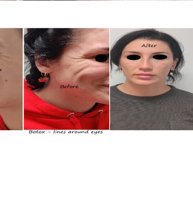 Before & after photos botox around eye – fresher, more appealing and youthful appearance.