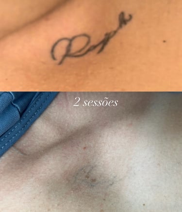 resultado de remocao de tatuagem