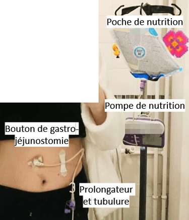 nutrition entérale