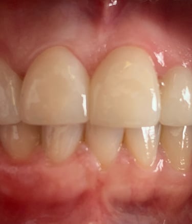 rehabilitación estética carillas 15-25 en disilicato de litio