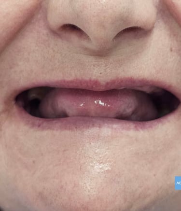 Paciente recibiendo implantes dentales en Badajoz