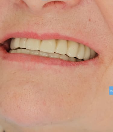 Sonrisa después de implantes en Badajoz
